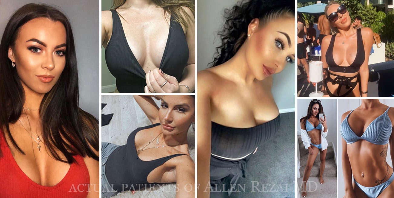 The Golden Ratio: Achieving “Natural Look” Breast Enhancements